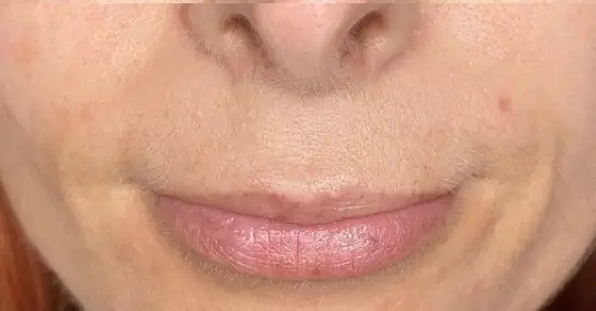 État des rides de la bouche avant le skinlift