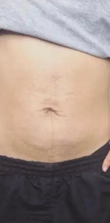 Atténuation du relâchement de la peau du ventre après Skinlift