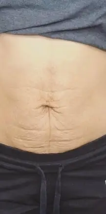 État du relâchement de la peau du ventre avant Skinlift