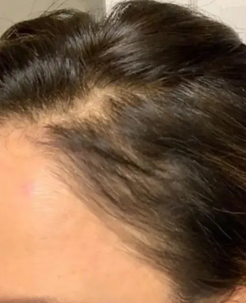 État des golfes frontaux après traitement hydrafacial keravive