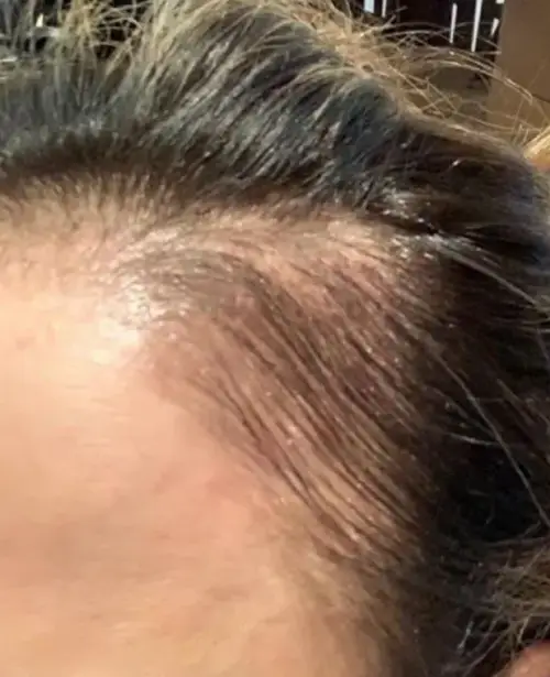 État des golfes frontaux avant traitement hydrafacial keravive
