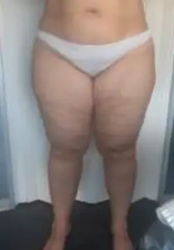 État des jambes après traitement expert minceur 6en1