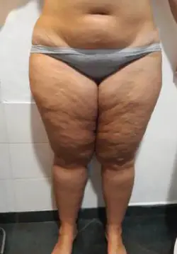 État des jambes avant traitement expert minceur 6en1