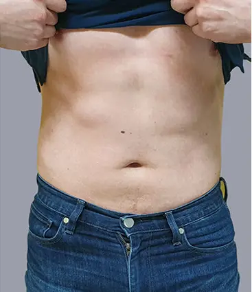 État abdominale après traitement 6 en 1