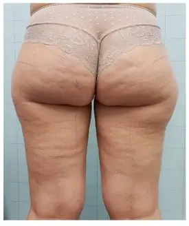 État des fesses & cuisses avant traitement minceur 6 en 1