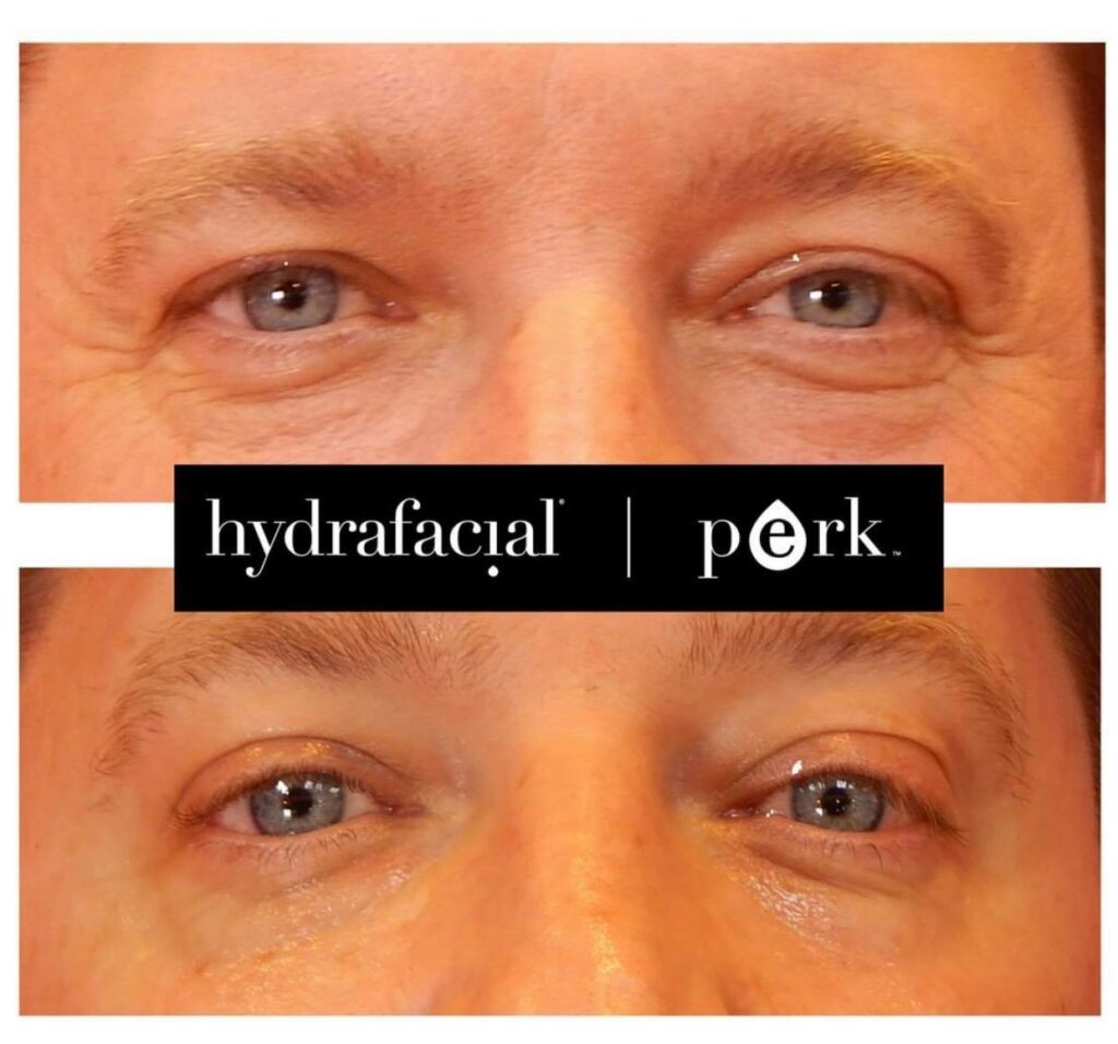 Hydraeyes avant après