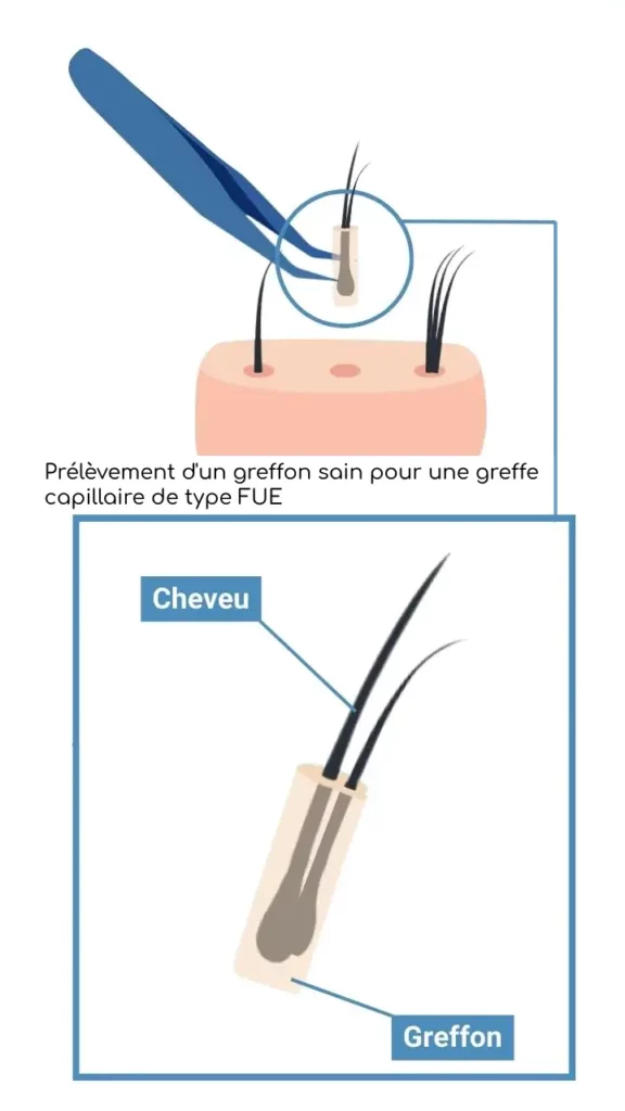 greffe capillaire FUE: explication du greffon