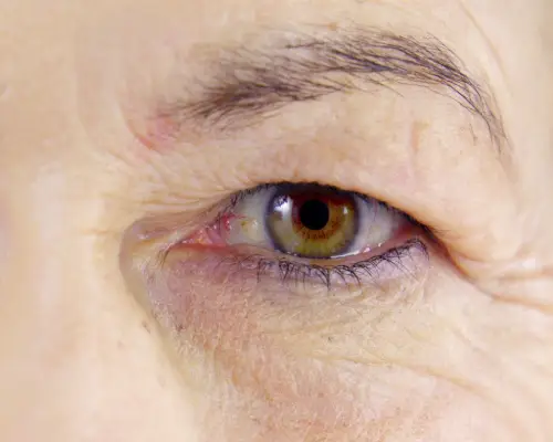 ptosis ou paupières tombantes