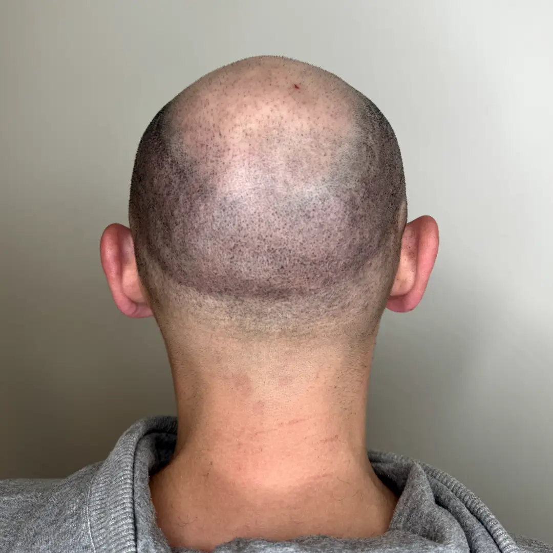 pelades homme recouvert après tricopigmentation (3séances)