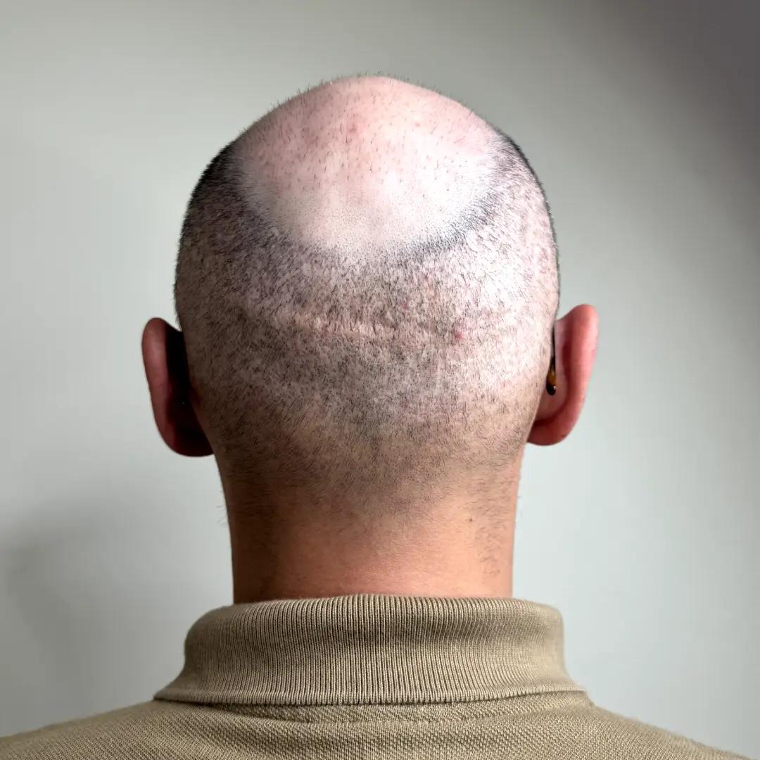 calvitie et pelades homme visibles avant tricopigmentation