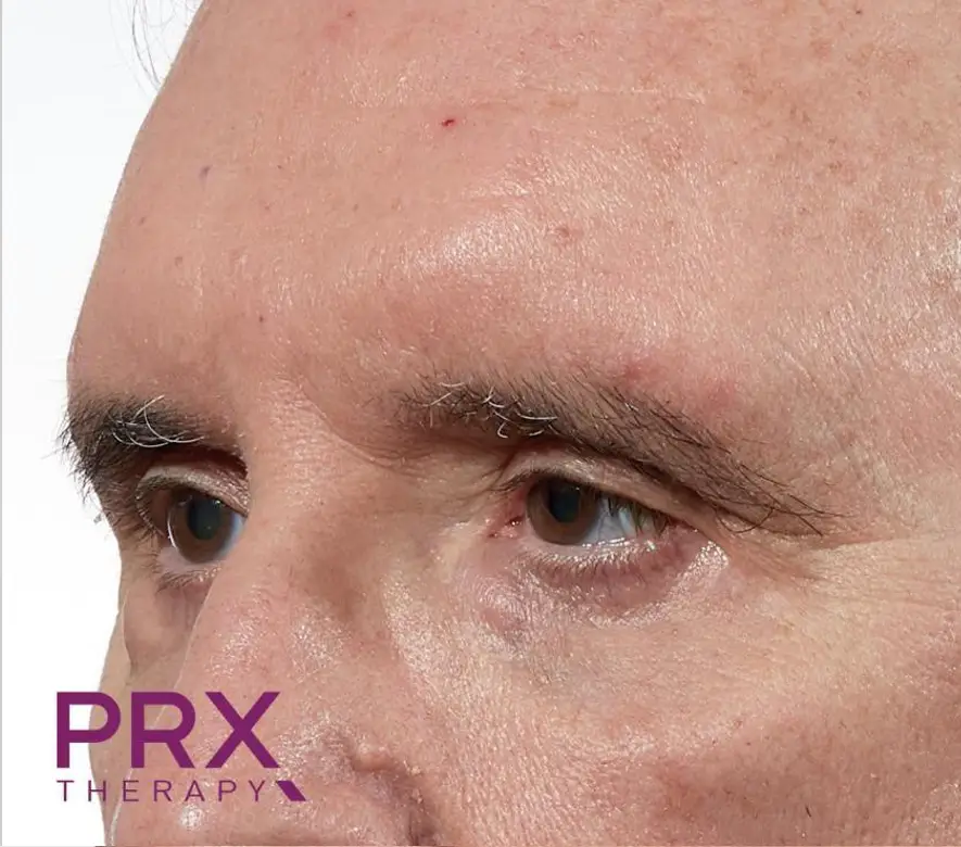 Après peeling PRX-T33 - atténuation des rides et disparition des imperfections