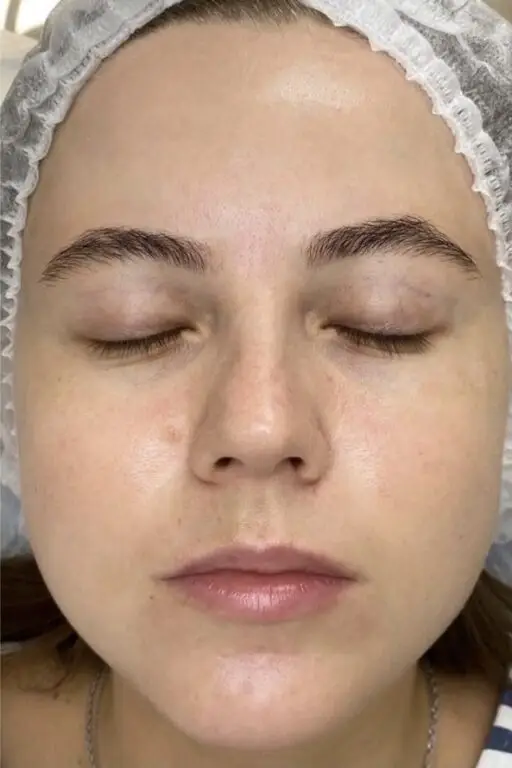 Après peeling PRX-T33 - disparition des traces d'acné et imperfections, éclat du teint