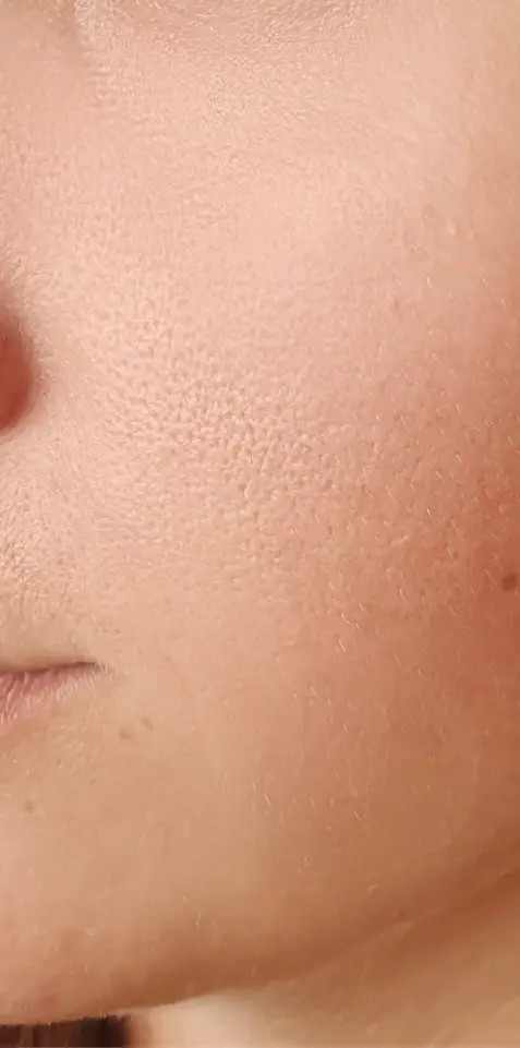Après peeling PRX-T33 - disparition du vieillissement de la peau et des ridules