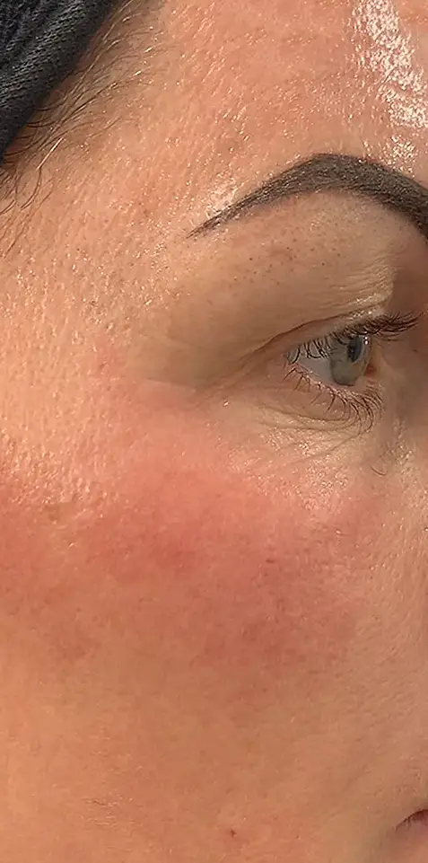 Après peeling PRX-T33 - atténuation des ridules et des imperfections