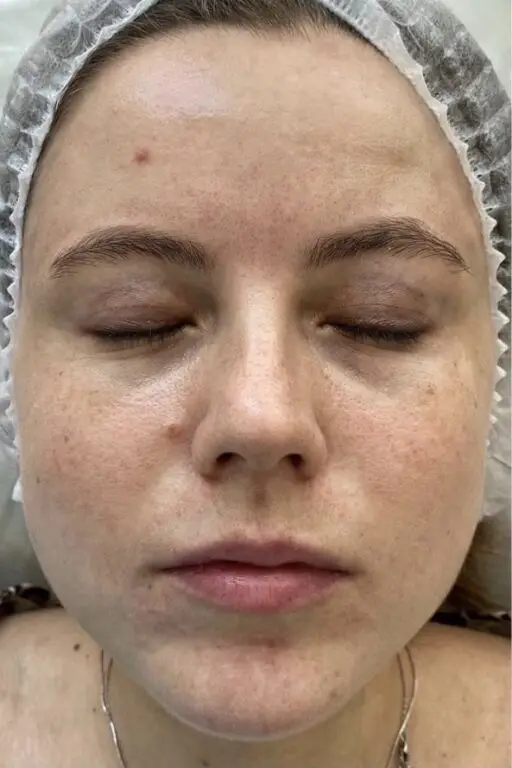 Avant peeling PRX-T33 - acné , imperfections de la peau et teint terne