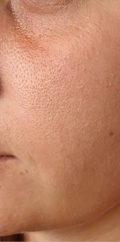 Avant peeling PRX-T33 - début de vieillissement de la peau ridules
