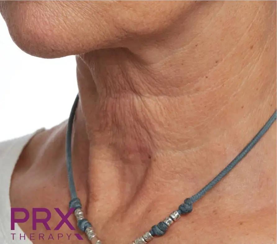 Avant peeling PRX-T33 - rides du cou marquées