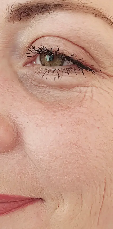 Avant peeling PRX-T33 - présence de rides et cernes d'expressions