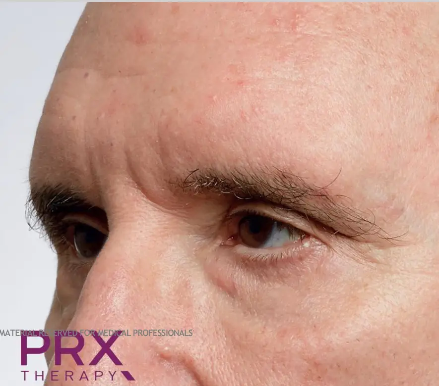 Avant peeling PRX-T33 - ride du lion et imperfections