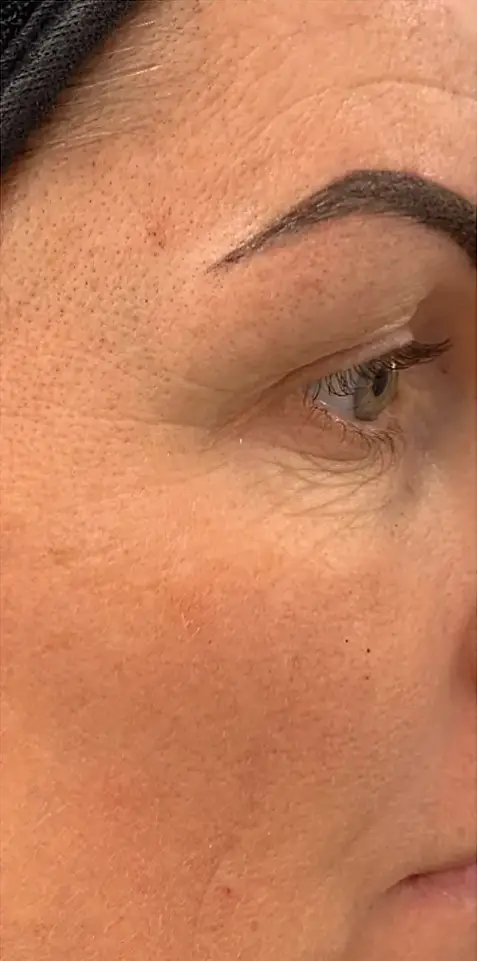 Avant peeling PRX-T33 - présence de ridules et d'imperfections