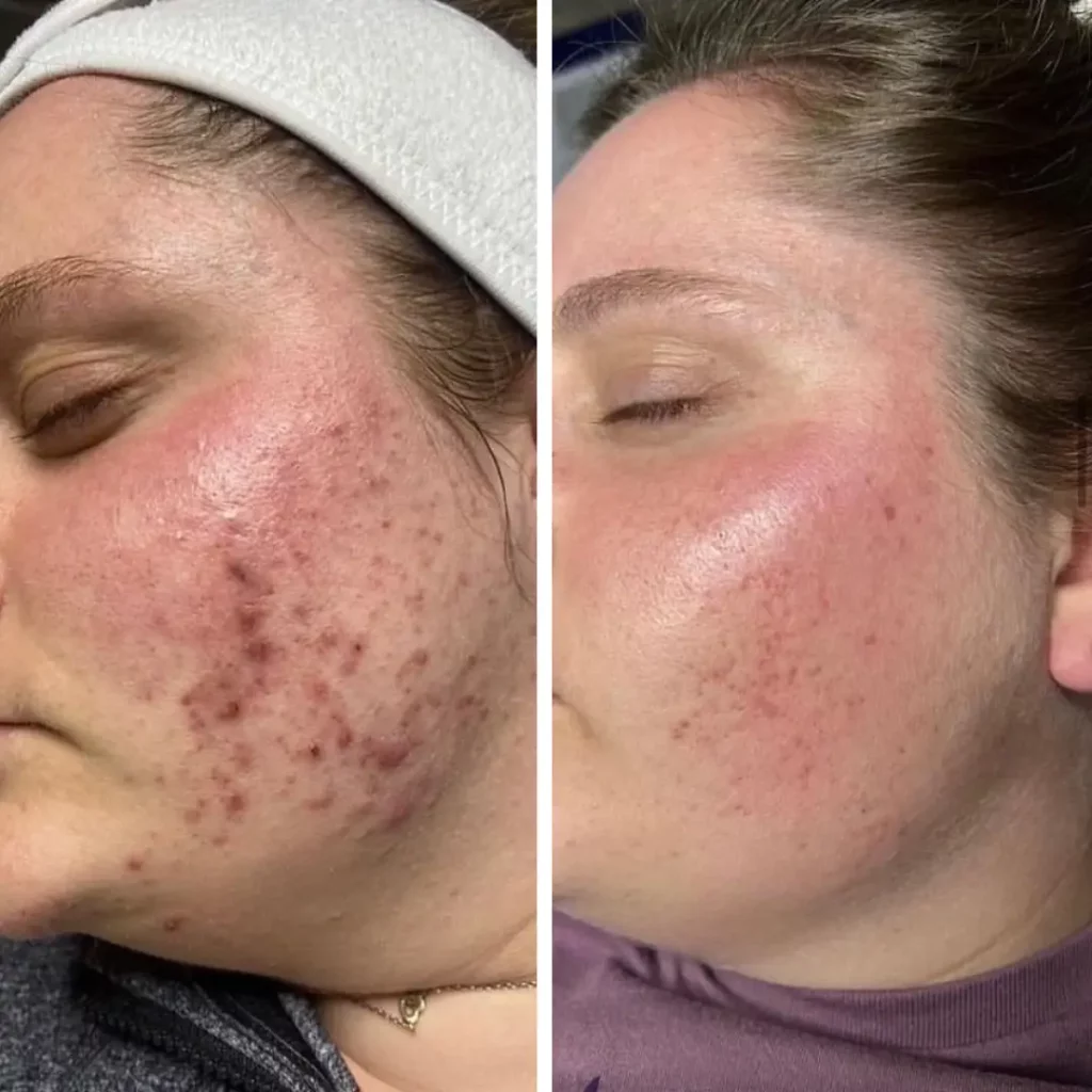 acné inflammatoire avant et après peeling aux algues à Metz et à Nancy
