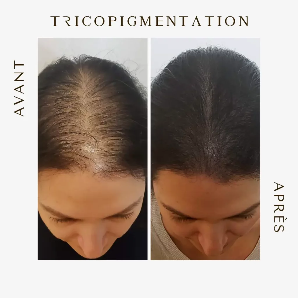 tricopigmentation femme
