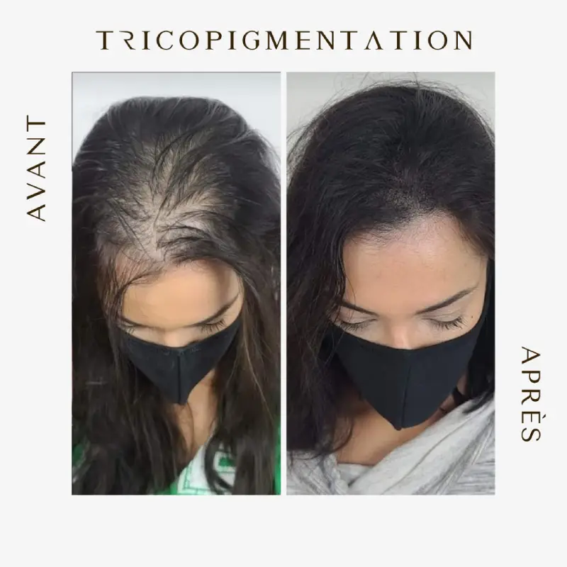 tricopigmentation pigmentation capillaire contre alopécie calvitie et pelades résultat avant après