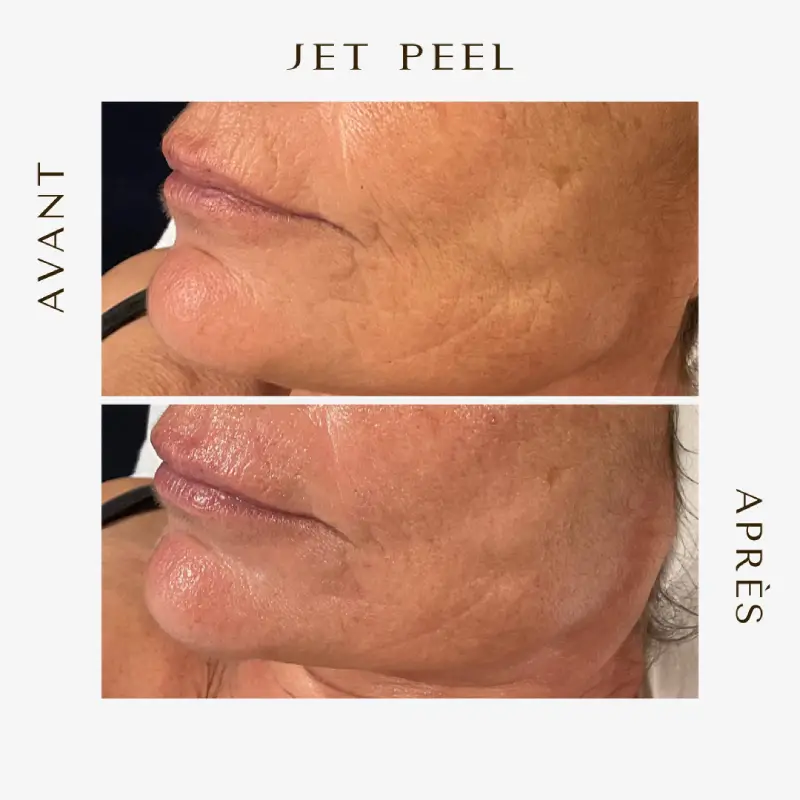 Avant après Jetpeel contour des lèvresl