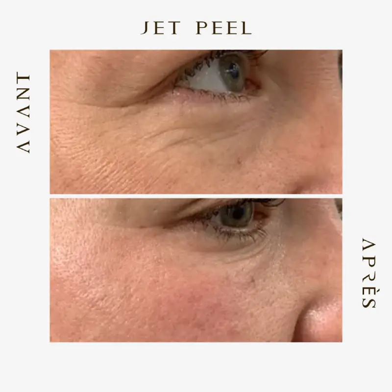 Avant après Jetpeel contour des yeux