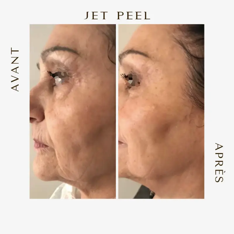 Avant après Jetpeel rides et relachement de la peau ensemble du visage