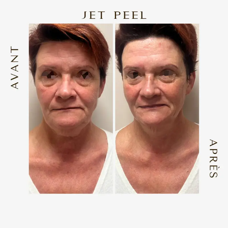 Avant après Jetpeel rides et relachement ensemble du visage