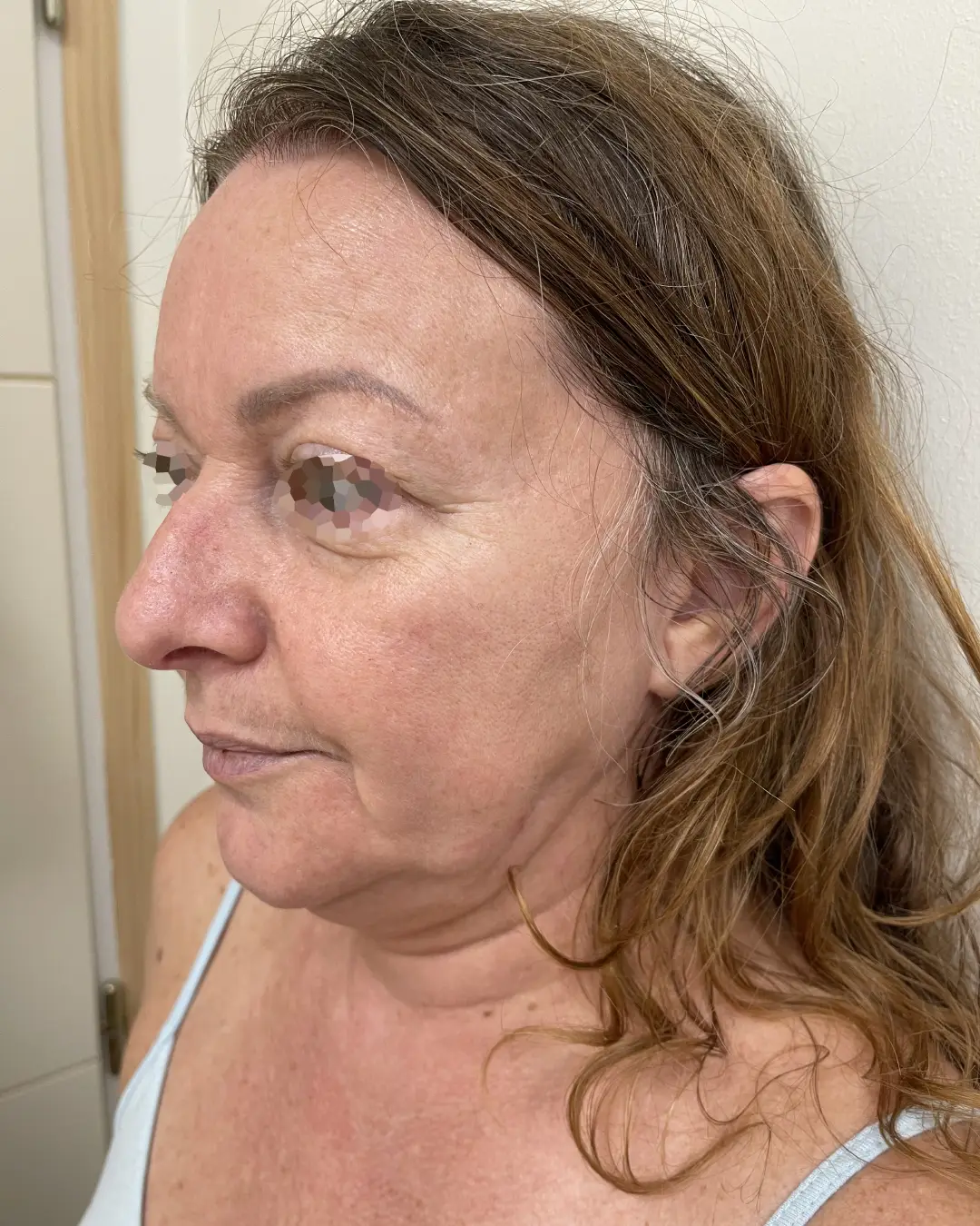 AVANT Cryolipolyse du menton : présence d'un bourrelet sous menton