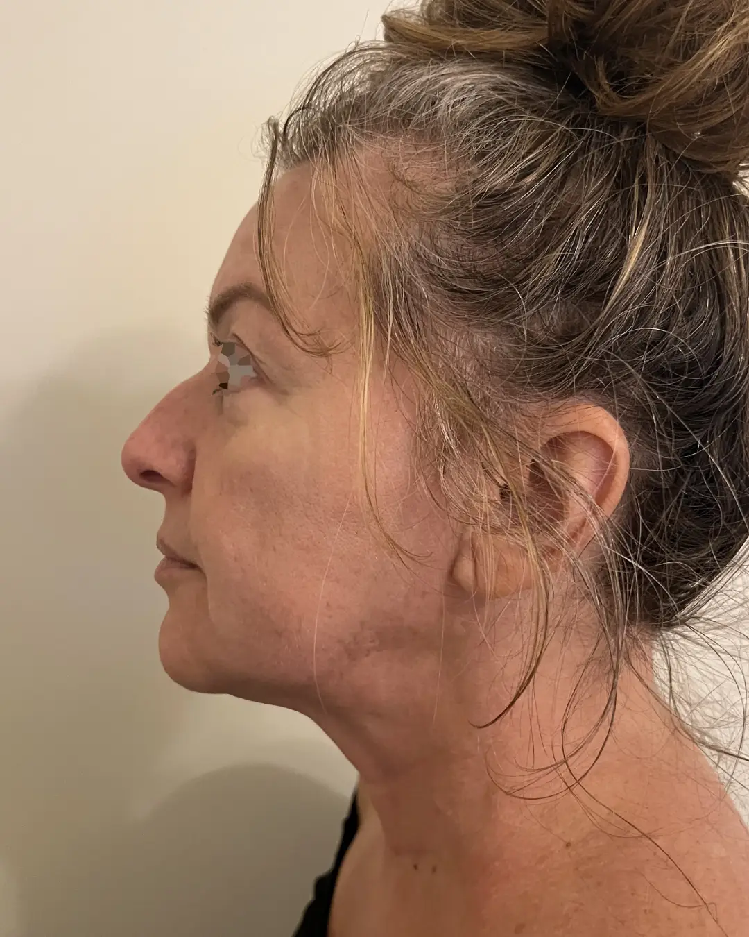 Après Cryolipolyse : disparition du double menton