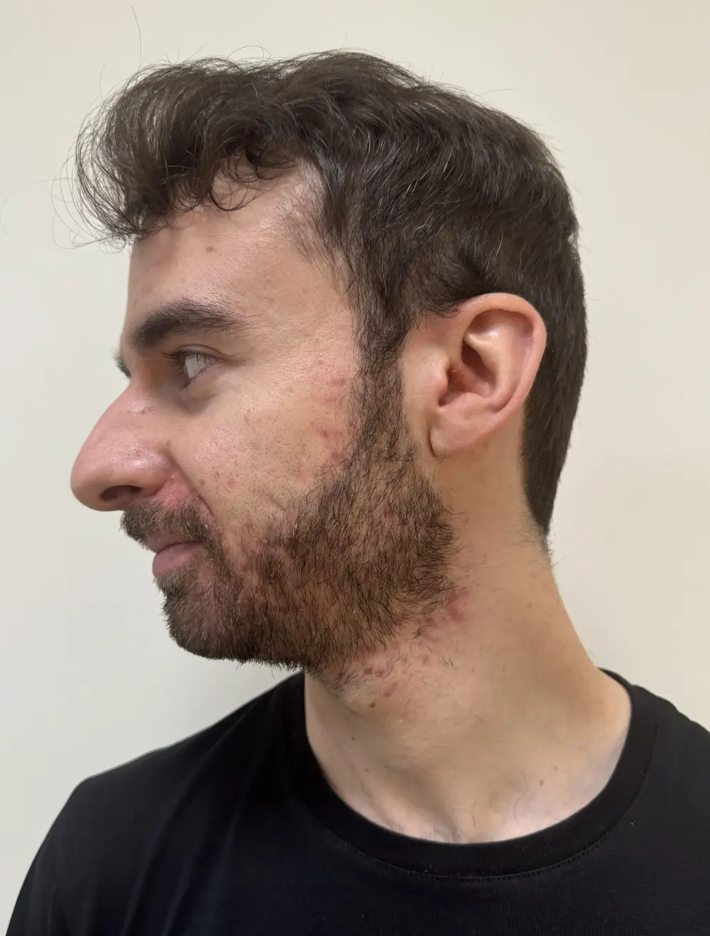 AVANT Jetpeel : imperfections et cicatrices d'acné ensemble du visage et plus particulière zone de la barbe