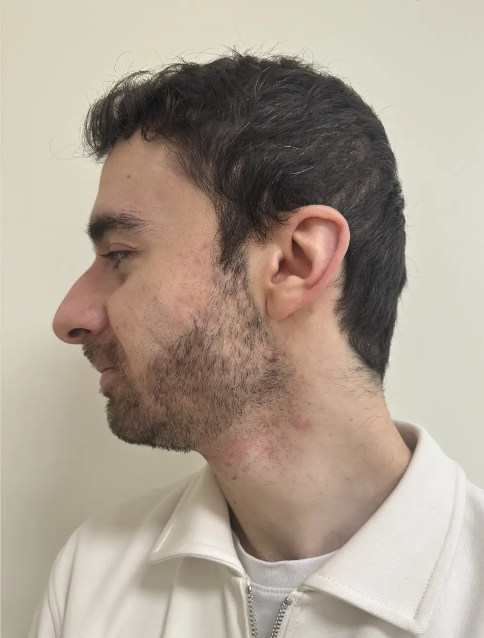 Après Jetpeel : atténuation des imperfections sur l'ensemble du visage, disparition de l'acné.