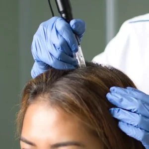 Microneedling capillaire