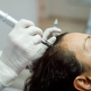 Microneedling capillaire traitement de stimulation de pousse des cheveux