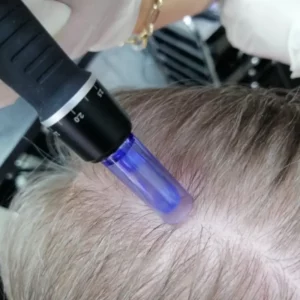 microneedling capillaire pénétration des actifs de croissance capillaire