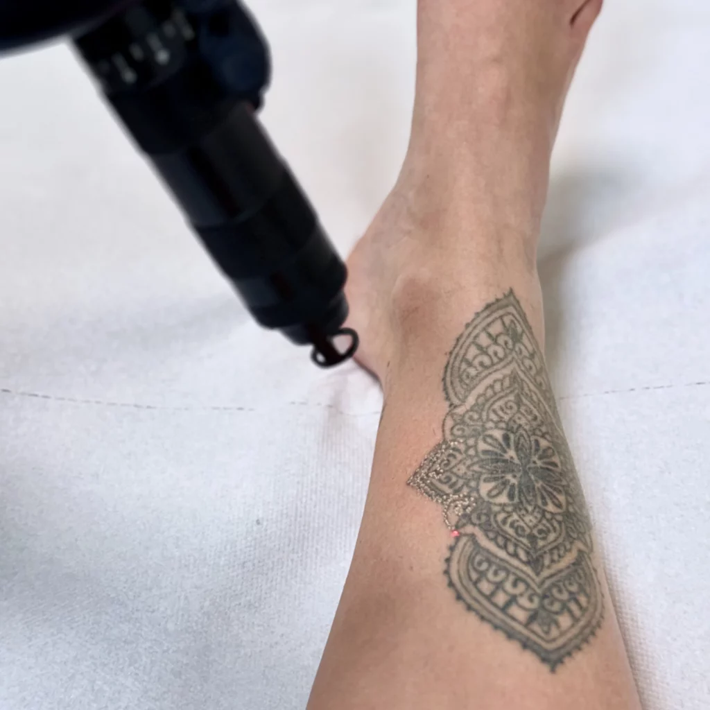 Détatouage