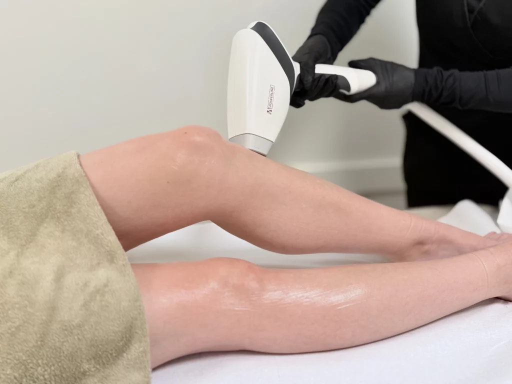 EpilationLaser