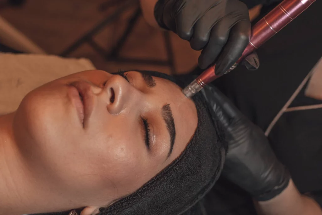 Microneedling