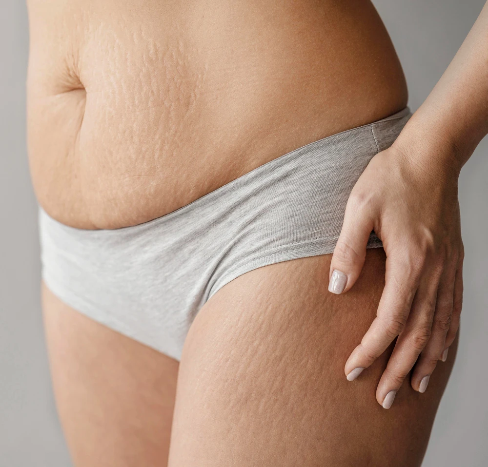 Body-marks