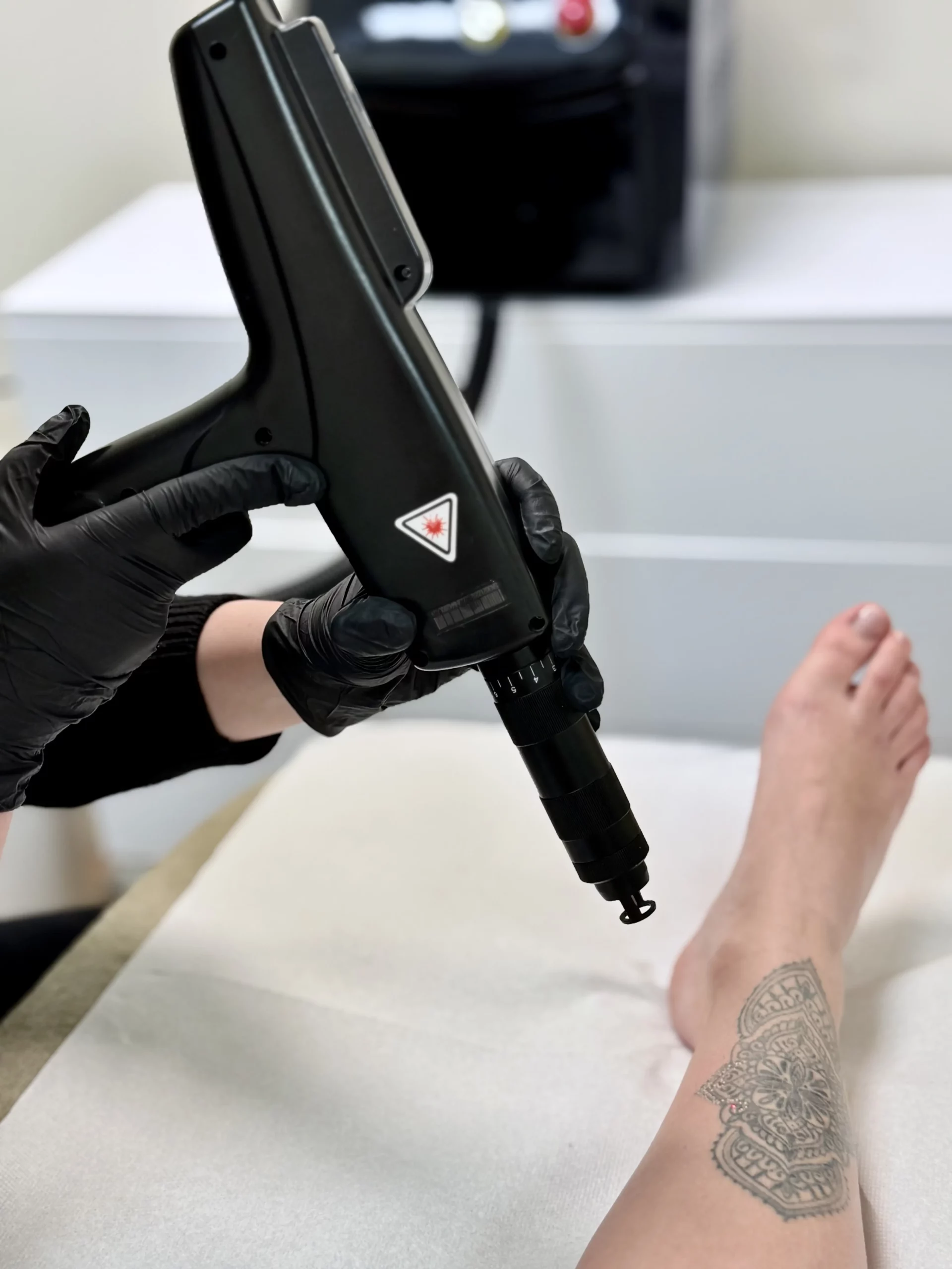 Séance de détatouage laser Picoseconde D4T à Nancy – A'Corps Beauté
