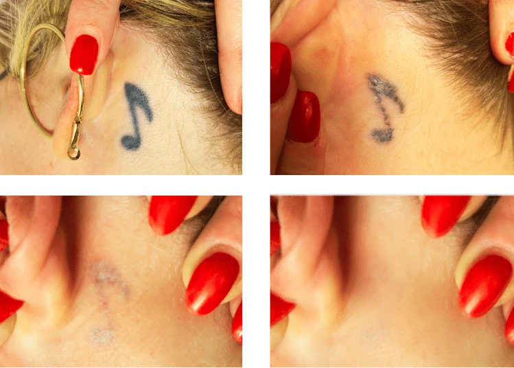 Avant après détatouage laser derrière l'oreille – 7 séances – A'Corps Beauté Nancy